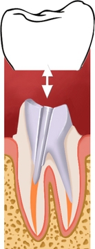 Une gingivite couronne dentaire