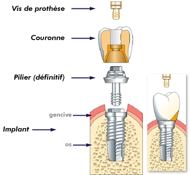 La prothèse peut être vissée dans le pilier, lui-même vissé dans l’implant. On parle alors de prothèse vissée.