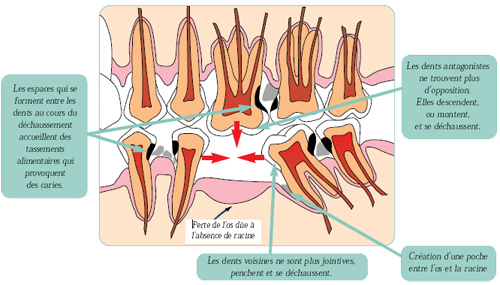 L'édentement