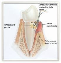 Parodontite modérée