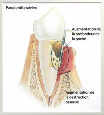 Parodontite sévère