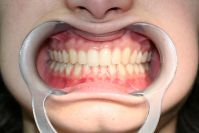 Aligneurs orthodontiques pour adultes