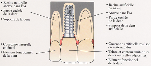 Un implant dentaire est une racine artificielle qui ressemble à une vis.