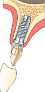 La prothèse peut être scellée (collée) sur le pilier qui est vissé dans l’implant. On parle de prothèse scellée.