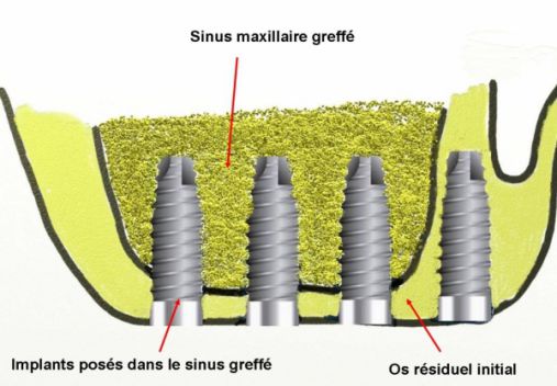 Graphisme d'un greffe sinusienne avec pose d'implants dentaires