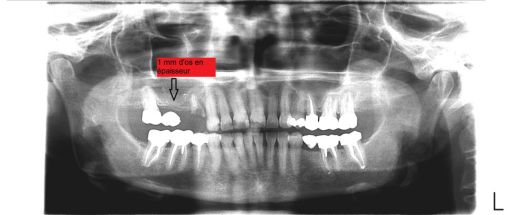 Radiographie panoramique dentaire avant extraction et greffe