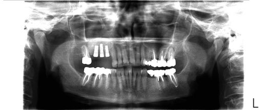 Sinus greffé et implants dentaires posés