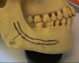 Le Nerf Dentaire Inférieur (NDI) chemine à l'intérieur de l'os.