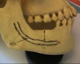 Les 2 molaires sont absentes. La hauteur osseuse disponible est matérialisée par la flèche.