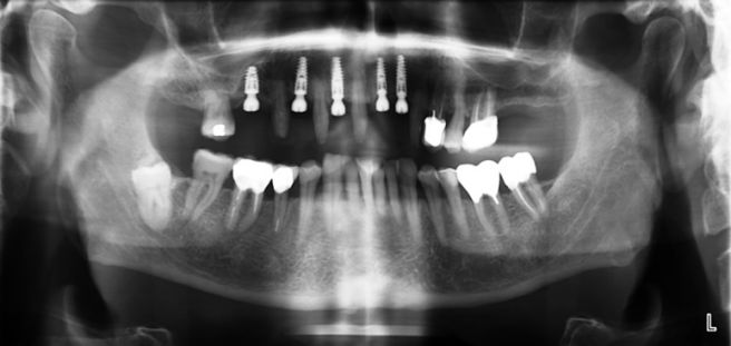 Toutes les dents sont radiographiées sur le même cliché