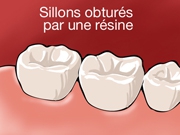 Sillons obtués par une résine