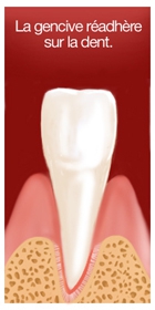 La gencive réadhère sur la dent.