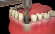 Implant dentaire en place