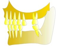 La première molaire supérieure est descendue de façon telle qu'elle devra être extraite.