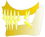 Les dents continuent à se verser dans tous les sens. La mastication ne se fait plus de ce côté de la bouche, les articulations de la mâchoire se trouveront perturbées (craquements, douleurs, bourdonnement, claquements, etc…).Une habitude nocive de grincement des dents peut alors s'installer (bruxisme).