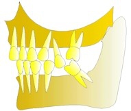 Une deuxième dent du haut après être trop descendue, devra être extraite à son tour. Le remplacement des dents sera techniquement plus difficile.