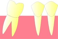 La dent se trouvant en arrière de la dent extraite, commence à se coucher vers l'avant (version).