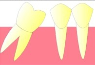 Elle se couche de plus en plus, jusqu'à réduire presque complètement l'espace qu'occupait la dent extraite (migration).
