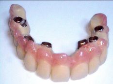 Dents avec implants