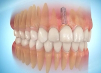 Prothèse dentaire terminée